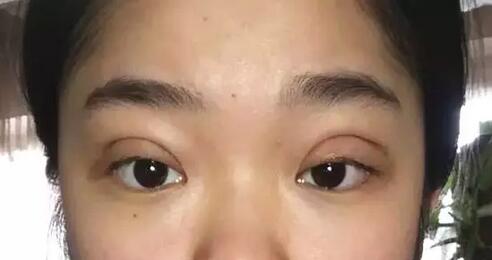 【0元整形】成都美上美招募10名眼修复模特~