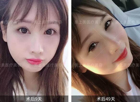 【0元整形】成都美上美招募10名眼修复模特~