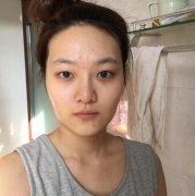 【卢相勋韩式微创双眼皮案例】韩国7日游顺带做了个双眼皮恢复很不错 width=