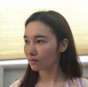 【面部吸脂对比图果案例】78天摆脱婴儿肥就是刚！ width=