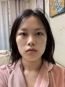 祁佐良长曲线下颌角截骨术案例：这个手术亲妈支持我做的~ width=