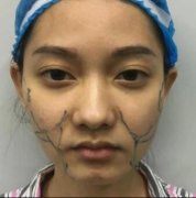 【昆山百达丽整形医院价目表】面部吸脂真人案例分享~ width=