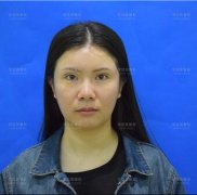 双下巴吸脂去除案例：大声和双下巴说色诱啦啦~ width=