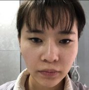 郑州悦美整形怎么样？闫海廷微创双眼皮案例+果图一览 width=