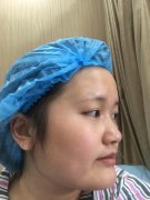 肥胖下颌角整形157天前后对比图案例：网红美女修炼记 width=