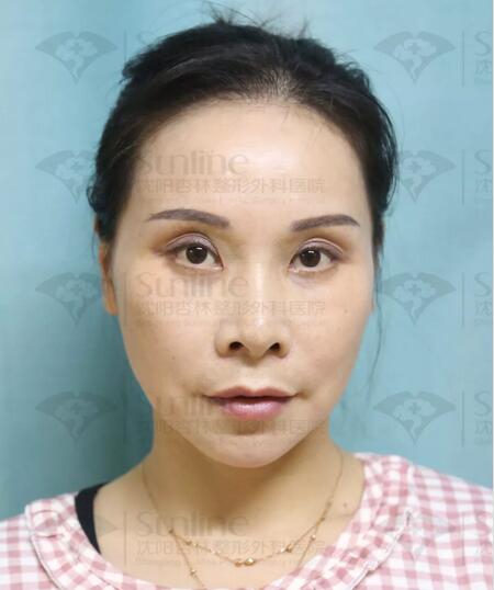 自体脂肪隆额头真实案例，  隆额头后的她尽显年轻化神话!