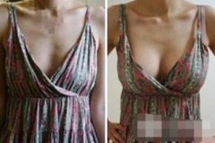 杭州新友好整形医院价目表，附韩式微创丰胸详细恢复过程~ width=