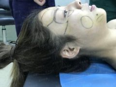 烟台鹏爱美容整形医院怎样?【垫鼻梁+自体脂肪面部填充86天恢复对比图】 width=