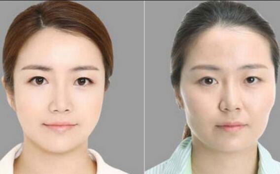 颧骨内推多少钱?哪些因素影响价格?