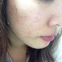 微针美容的大概费用是多少?微针美容贵吗?