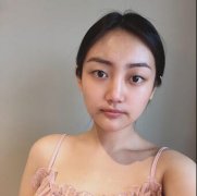 【郑州风信子整形医院价目表】拉线双眼皮对比图案例分享 width=