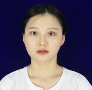 调节下颌角肥胖：长曲线下颌角截骨整形对比图恢复分享~ width=