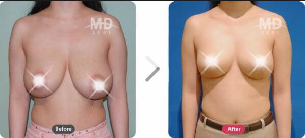 巨乳-缩小大概多少钱？心里没数啊~