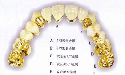 黄金烤瓷牙的价格大概多少比较合理?