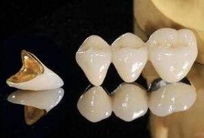 黄金烤瓷牙的价格大概多少比较合理?