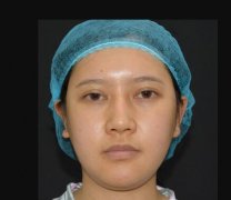 泛美泓涵面部吸脂对比图案例：婴儿肥30多天就没有了! width=