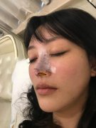耳软骨垫鼻尖对比图案例：72天恢复变成小仙女 width=