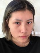 名人医美连锁面部吸脂瘦脸恢复案例：脸小好看硬道理 width=