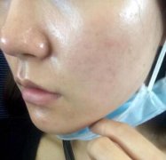 黑脸娃娃改良色素沉著：黑脸娃娃美白日记 width=