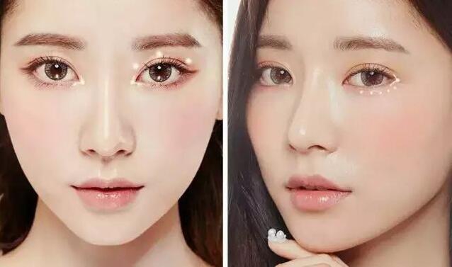 亚韩割双眼皮多少钱?贵不贵喃?