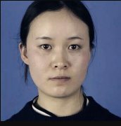 【沈阳名流美容医院案例】切开双眼皮解决单眼皮尴尬 width=