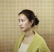 卓彦美容医院拉线双眼皮1：34天对比图：种草了热巴的双眼皮惹 width=