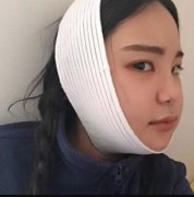 面部光纤溶脂恢复对比图：大脸星人的克星~ width=