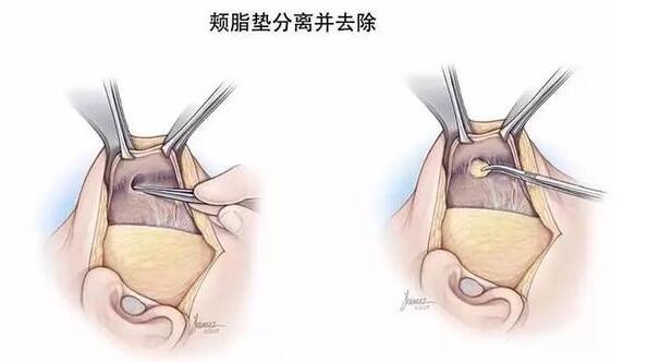 去颊脂垫有副作用吗?谁能告诉我~