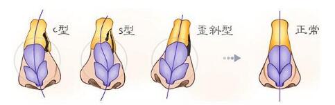 歪鼻手术有风险吗?到底有哪些呢?