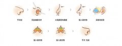 水滴鼻整形是怎样的? width=