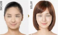 注射瘦脸的价格是多少? width=