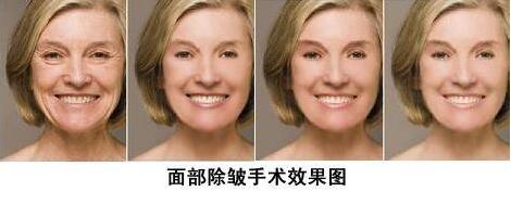 像束激光除皱的果真的很好嘛?
