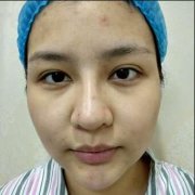 李佳融光纤面部吸脂瘦脸对比图：真人案例恢复过程 width=