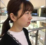 张英焕玻尿酸丰下巴案例：拯救下巴后缩的秘密武器 width=