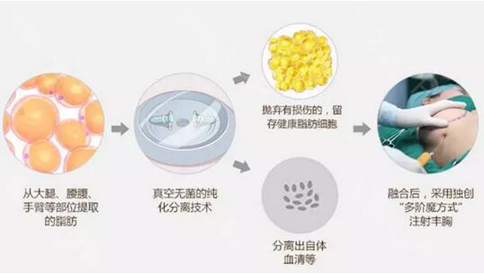 自体脂肪隆胸都有哪些优势？为啥那么受欢迎？