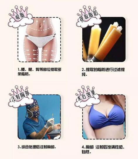 自体脂肪隆胸都有哪些优势？为啥那么受欢迎？