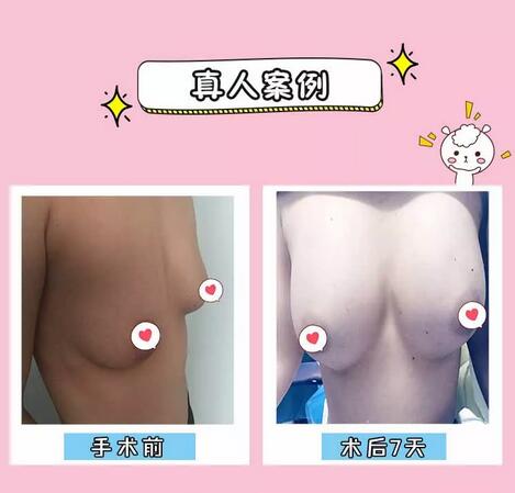 自体脂肪隆胸都有哪些优势？为啥那么受欢迎？