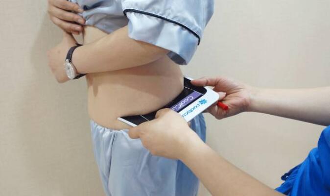 韩式共振吸脂减肥果好吗?真实案例呈上