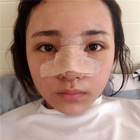 肥厚鼻尖矫正术风险大吗?想变美就这么难吗?
