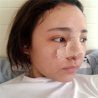 肥厚鼻尖矫正术风险大吗?想变美就这么难吗?