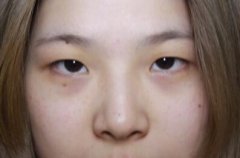 看了张姣姣割双发眼皮的对比图后，我也去做了一个~ width=