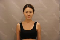 刘春军医生自体脂肪隆胸案例对比分享~ width=