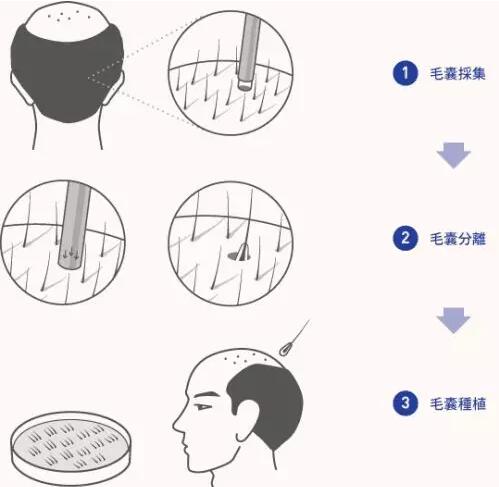人工植发多少钱？小衰带各位详细了解~