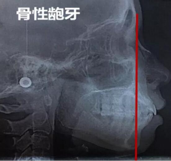 侯振杰答：骨性牙齿数量少，做半口矫正就好？