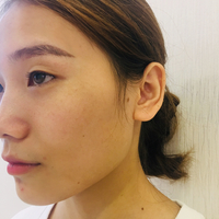 伊美尔注射瘦脸价格多少?价格贵吗?