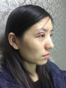 伊美尔紫竹双眼皮修复对比图：1-97天的气质变化 width=