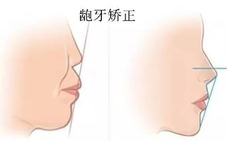 珠海九龙口腔医院答：儿童牙齿还没换完不能做牙齿矫正？