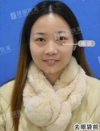 超声波去眼袋去掉多年眼袋的我，终于敢大胆晒素颜照了！