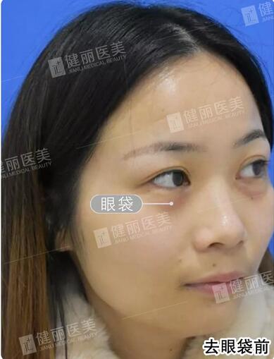 超声波去眼袋去掉多年眼袋的我，终于敢大胆晒素颜照了！