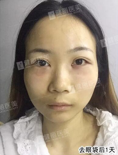 超声波去眼袋去掉多年眼袋的我，终于敢大胆晒素颜照了！
